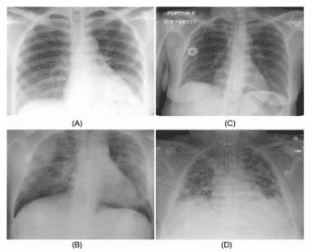 Examples of CXR images